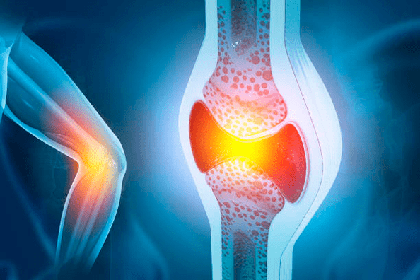 Prevencija bolesti zglobova