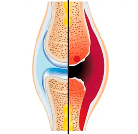 Struktura zdravog i istrošenog zgloba s oznakom hrskavičnog tkiva i sinovijalne tekućine